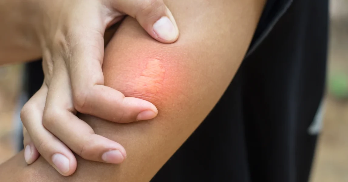 ¡Picaduras Peligrosas! Guía Urgente para Protegerte Este Verano