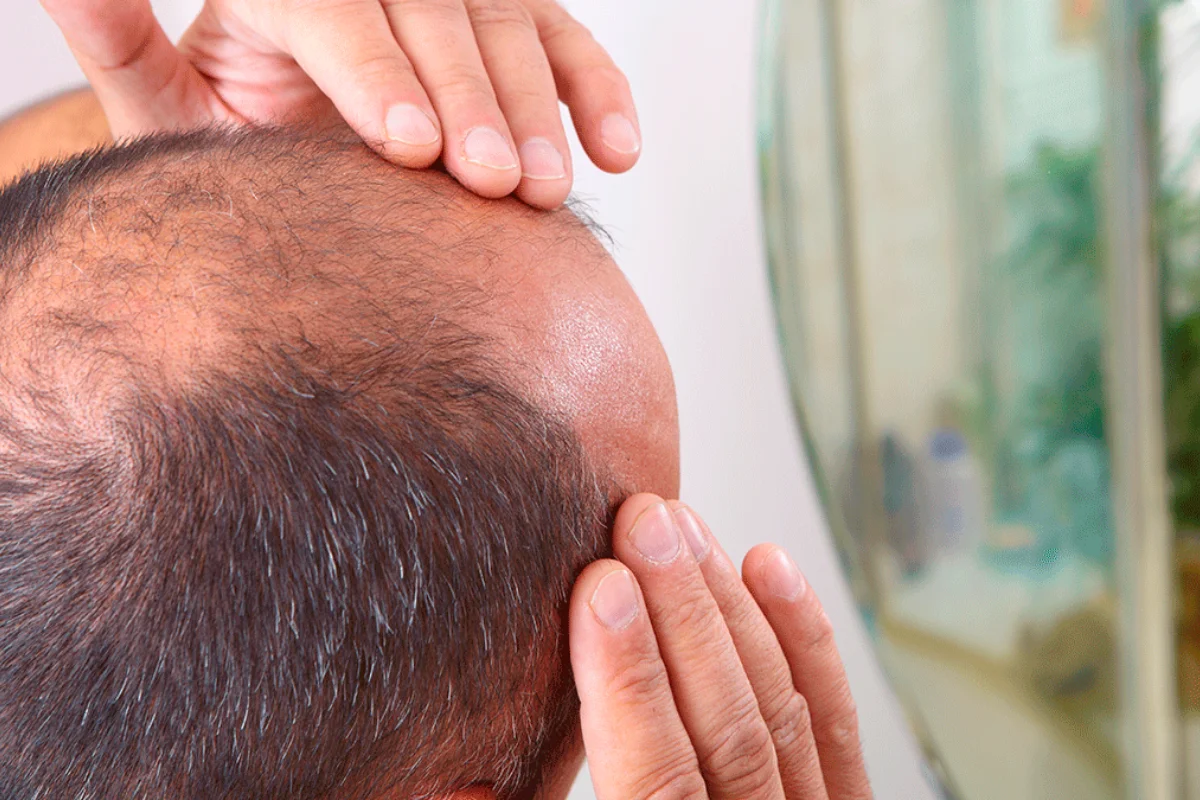 Sin cirugía y en 8 semanas: Científicos crean fórmula tópica que combate la calvicie y la alopecia