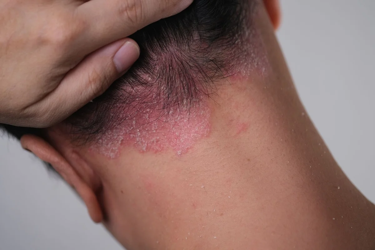 Psoriasis: a qué edad suele aparecer, quiénes tienen mayor probabilidad de padecerla y cómo controlarla
