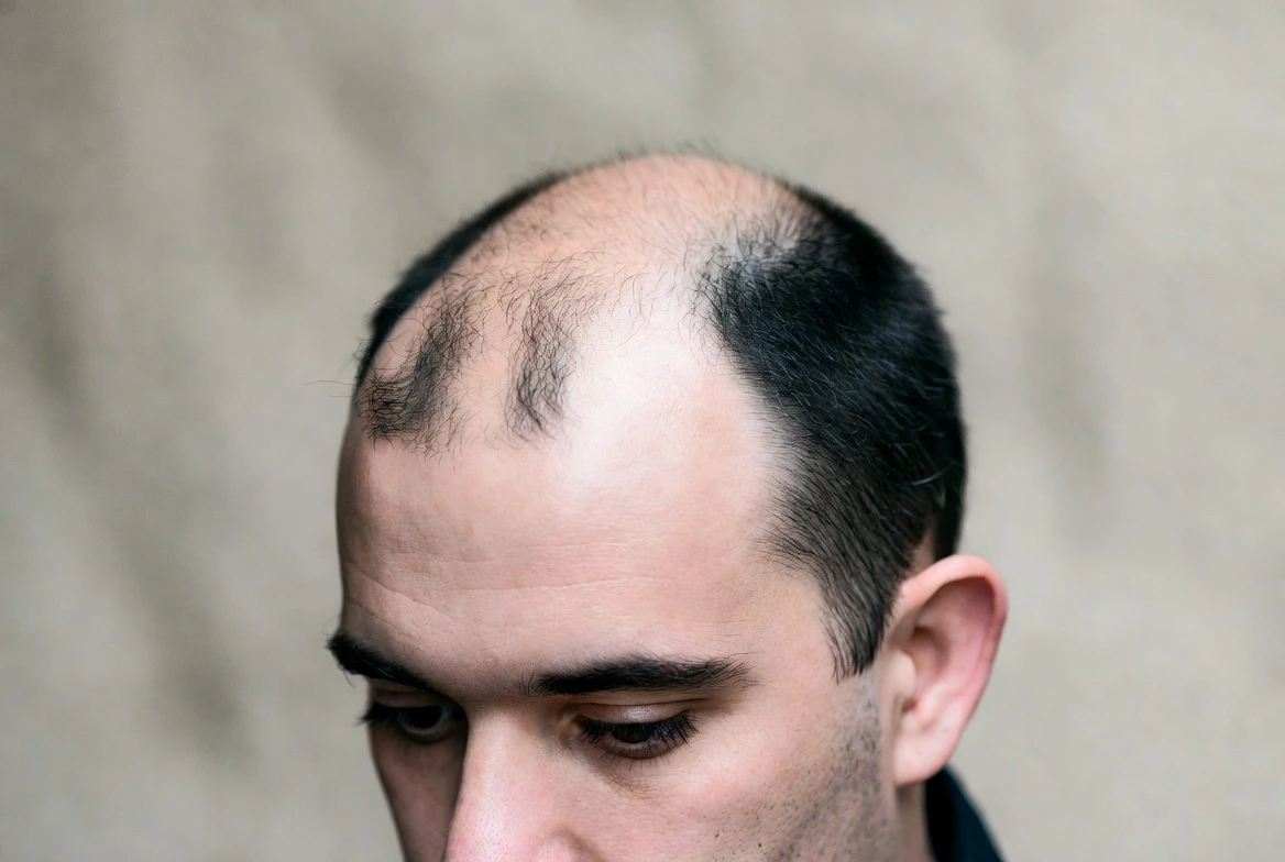 Implante capilar se adelanta en Chile: 24% de los pacientes tiene entre 21 y 35 años y crece consulta por alopecia masculina